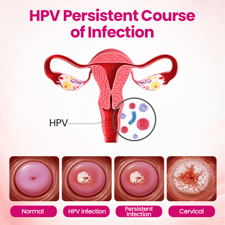 Timilk® IntiDefend Anti-HPV Interferon Gel -