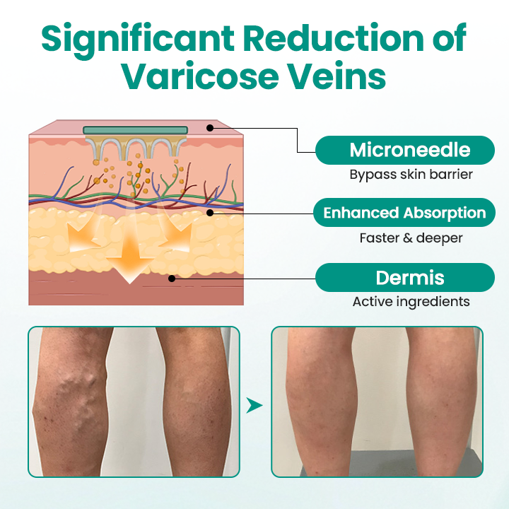 Timilk® LegRenew Varicose Veins Patch💧 24h Relief Microneedle Patch – Naturally Fade Varicose Veins