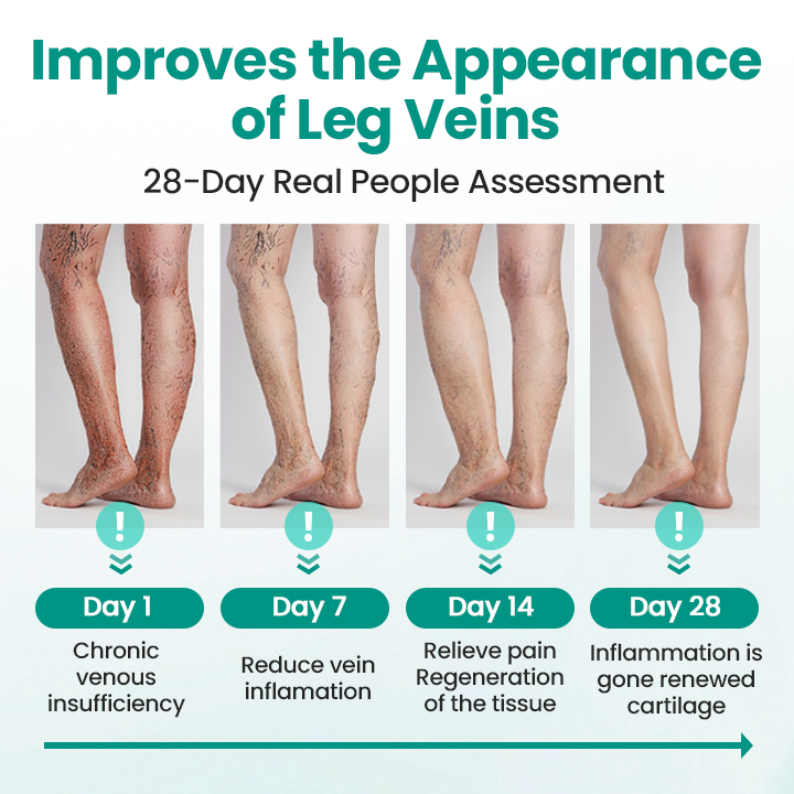 Timilk® LegRenew Varicose Veins Patch💧 24h Relief Microneedle Patch – Naturally Fade Varicose Veins