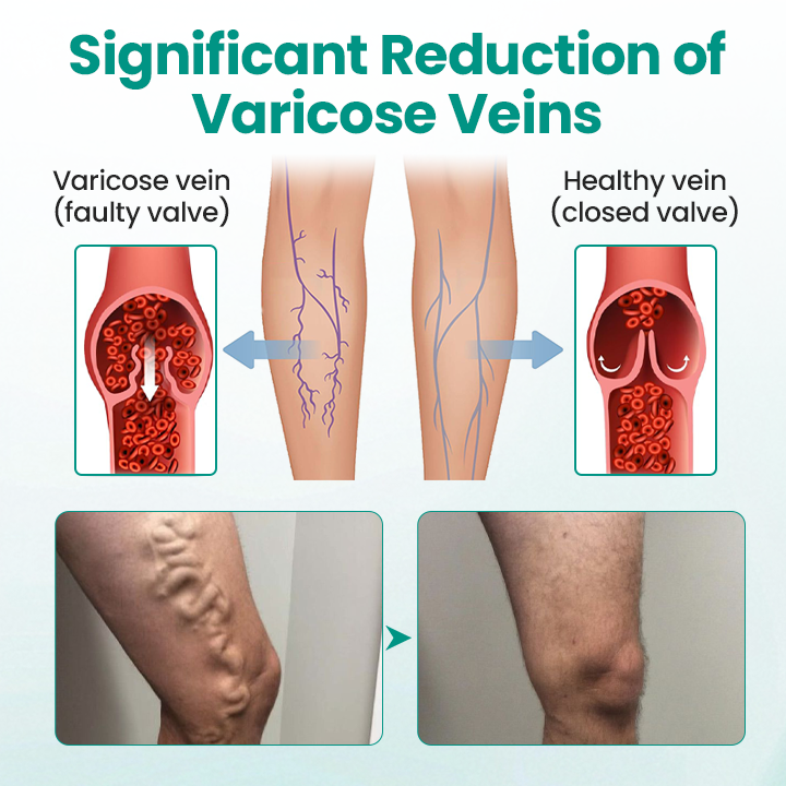 Timilk® LegRenew Varicose Veins Patch💧 24h Relief Microneedle Patch – Naturally Fade Varicose Veins