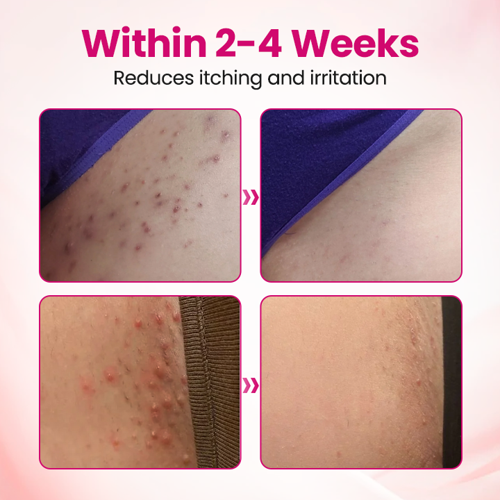 Timilk® IntiDefend Anti-HPV Interferon Gel -