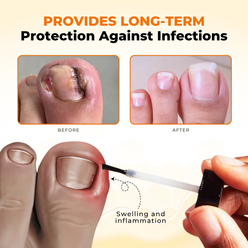 Timilk® NailRevive Bee Venom Anti-fungi Solution