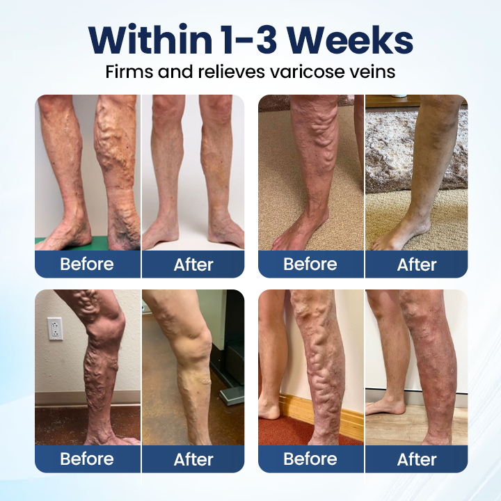 Timilk® Deep Vein Repair Microneedle Patch