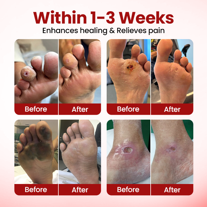 Timilk® VitaGluco Diabetic Care Cream — 48-Hour Visible Swelling Relief