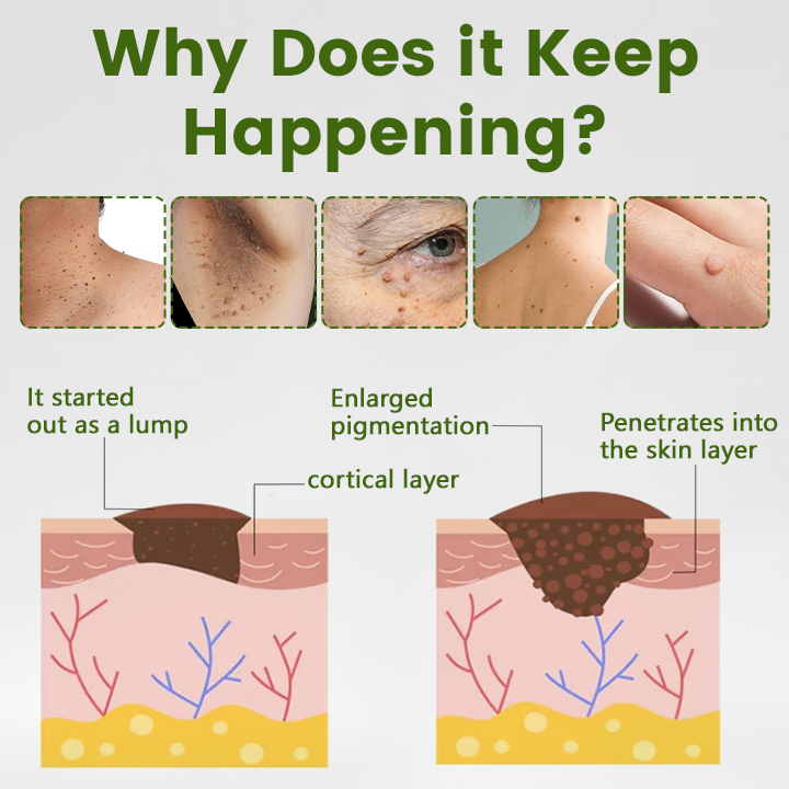 Timilk® ThujaClear Botanical Wart Cream