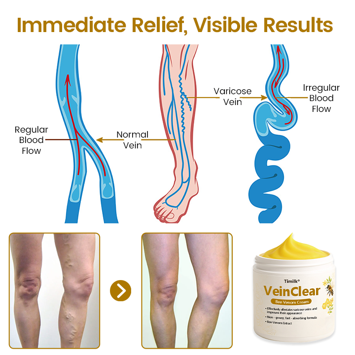 Timilk® VeinClear Bienengiftcreme |✨ Sichtbare Linderung in nur 7 Tagen! 🦵🌿