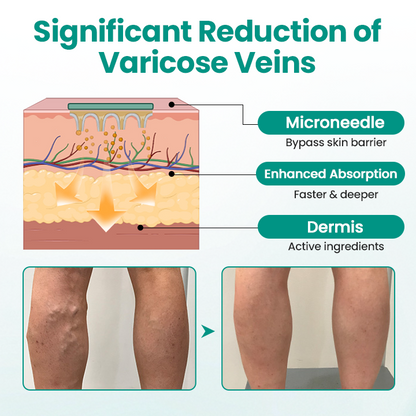 Timilk® LegRenew Varicose Veins Patch💧 24h Relief Microneedle Patch – Naturally Fade Varicose Veins