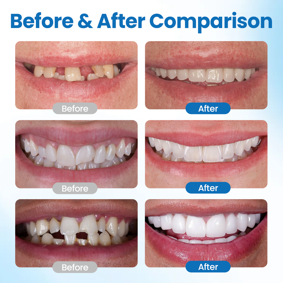 Timilk® SmileMend Tooth Repair Filling Kit