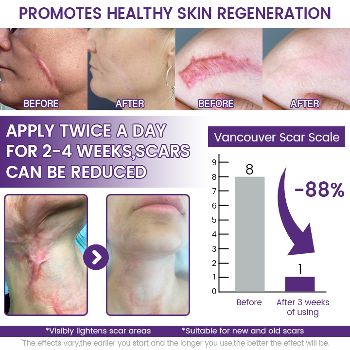 Timilk® ReGenScar Stem Cell Scar Gel-1