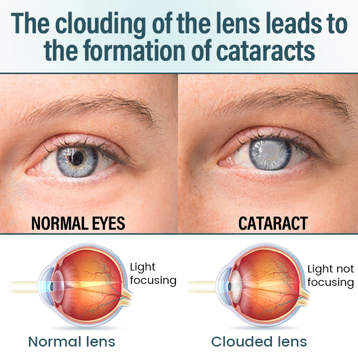 Timilk® OptiFusion Nano Eye Drops Serum —Nano Technology Restores Clear Vision,  No Glasses, No Surgery