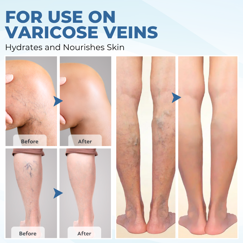 Timilk® TheraVein Varicose Herbal Spray