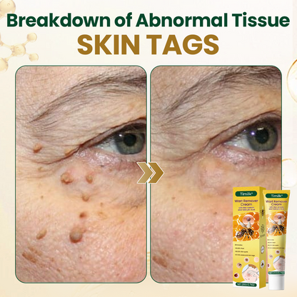 Timilk® Wart Remover Cream with Bee Venom and Salicylic Acid – Skin Tag Removal & Skin Repair Formula for Face and Body
