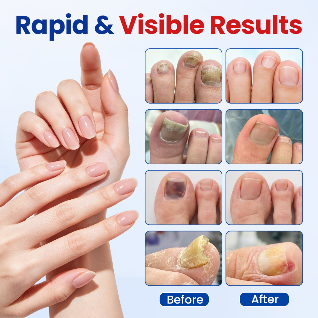 Biancat®Fungal Nail Repair Patches
